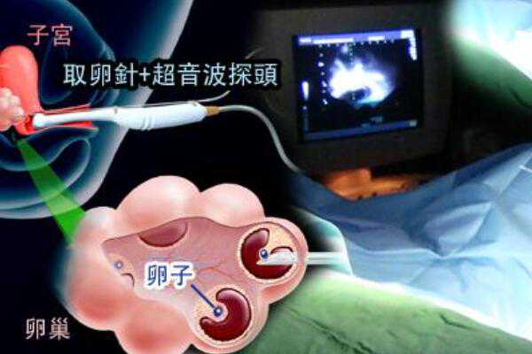北京私人医院供精供卵怎么样,＂借卵＂生子的真实分享。